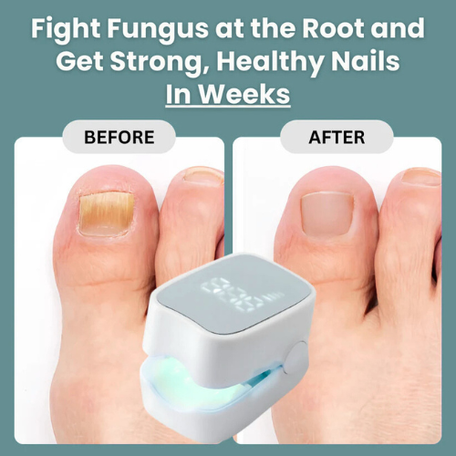 VeloriaNail Pro™ - Nail Fungus Laser Device