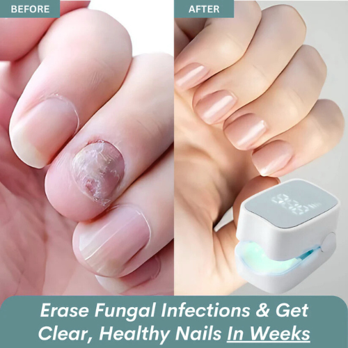 VeloriaNail Pro™ - Nail Fungus Laser Device