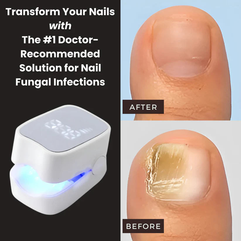VeloriaNail Pro™ - Nail Fungus Laser Device