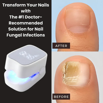 VeloriaNail Pro™ - Nail Fungus Laser Device